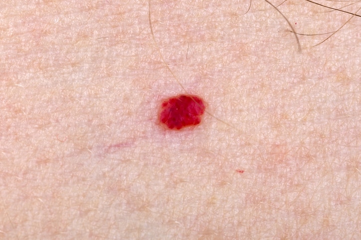 Cherry angioma