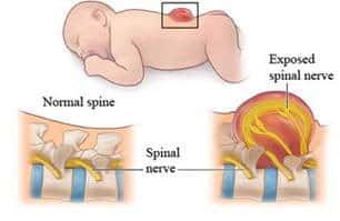 Diagram explains spina bifida with graphic of a baby and close up views of the spine