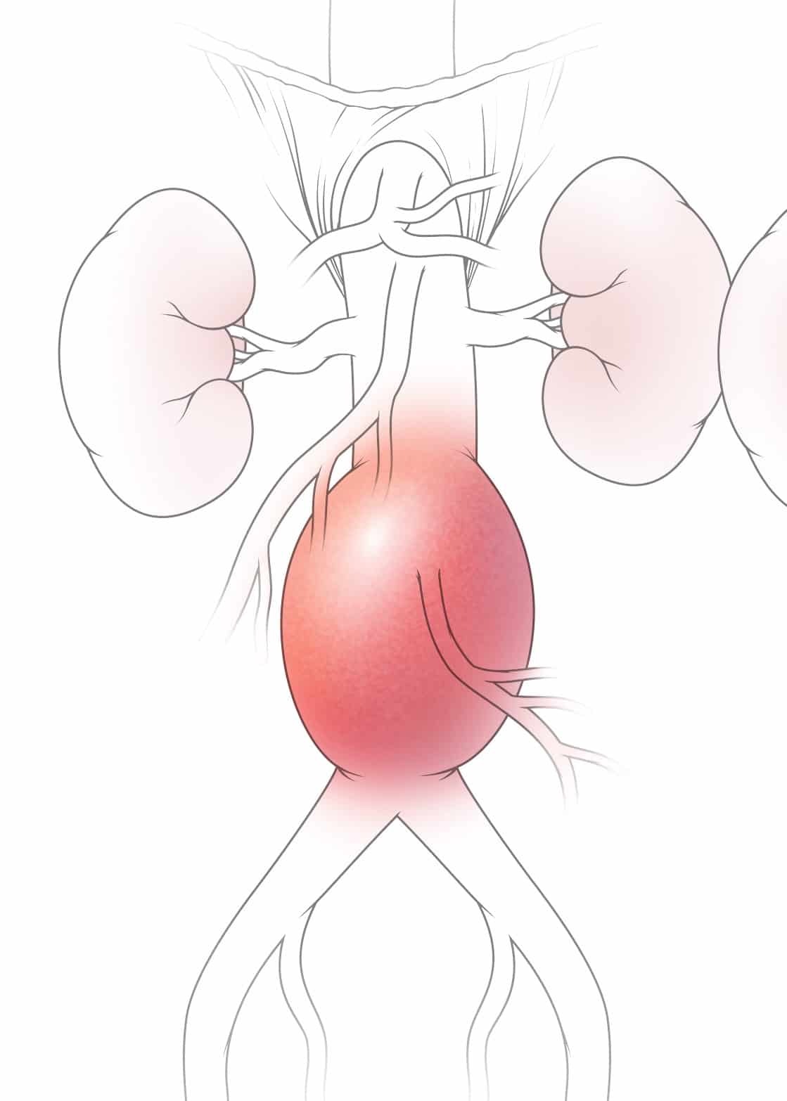 Graphic diagram depicting an Abdominal Aortic Aneurysm