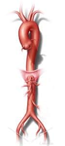 Graphic diagram of an aortic aneurysm