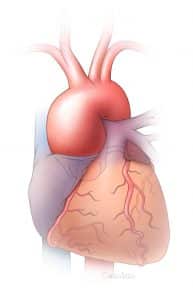 Graphic diagram of an aortic dissection