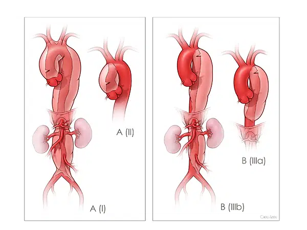 Diagram depicting the different types of aortic dissections