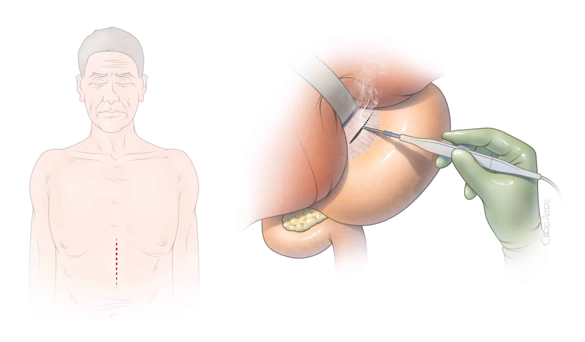 UT Physicians | Median arcuate ligament syndrome (MALS)