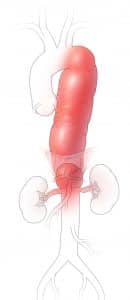 Diagram depicting a Thoracoabdominal Aortic Aneurysm (TAAA)