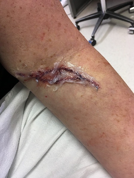 Photo of Yvette Ellerbe's arm where she had a spot removed. (Photo courtesy of Yvette Ellerbe)