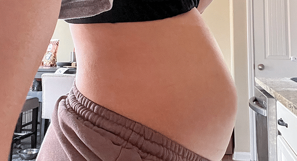 Distended belly