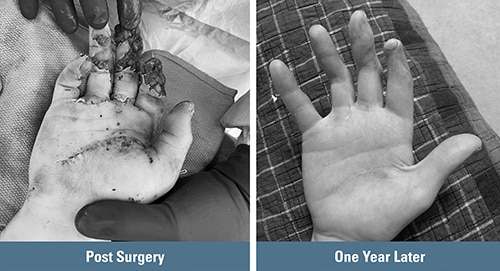 Fireworks hand injury post surgery and results one year later