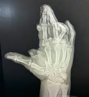 Fireworks injury patient hand x-ray image