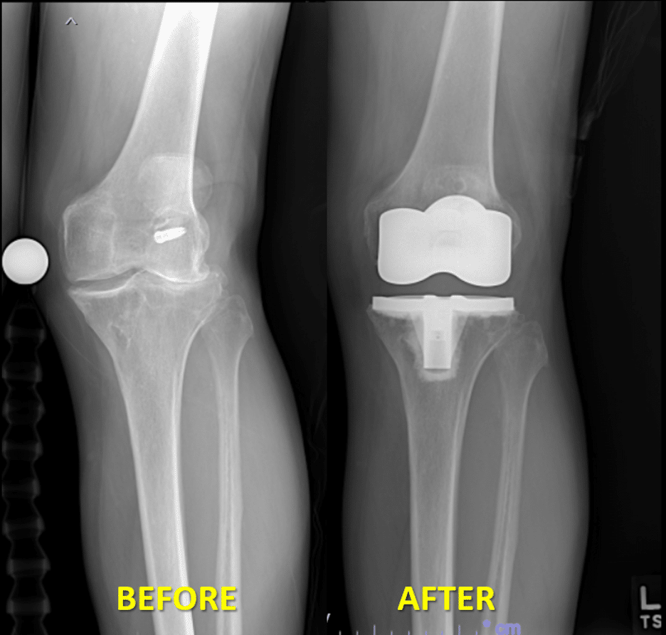 Roy Gray's x-rays before and after his knee replacement