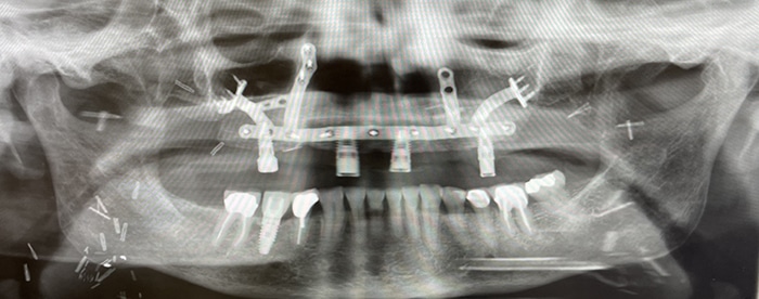 Dental X-ray of patient