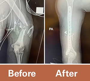 Before and after x-rays of Sgt. Sam Cleveland’s humerus after he was shot