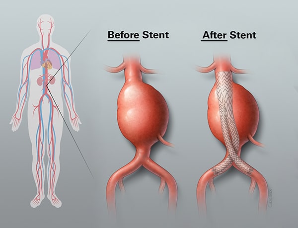 Stent Illustration before and after