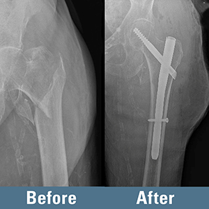 X-ray images of a before and after treatment of a hip fracture
