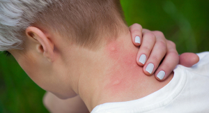 Young female with mosquito bites on the back of her neck