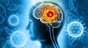 Visual concept of brain tumor in women