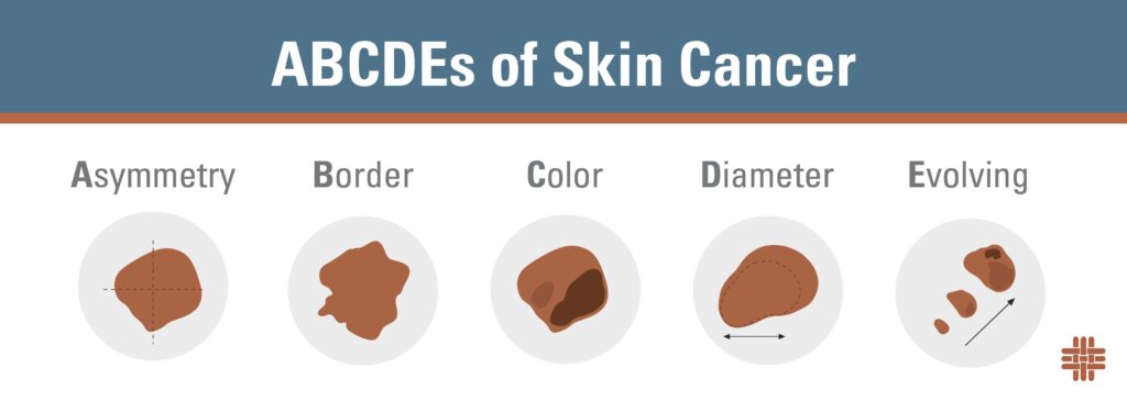 ABCDEs of Skin Cancer infographic, Asymmetry, Border, Color, Diameter, Evolving