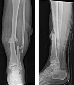 Donald's X-ray image of broken bone