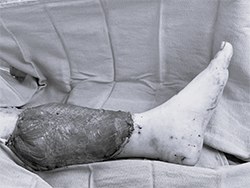 Donald's lower leg undergoing the plastic surgery procedure
