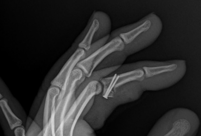John Longoria index finger PIP ORIF with hemi-hamate arthroplasty