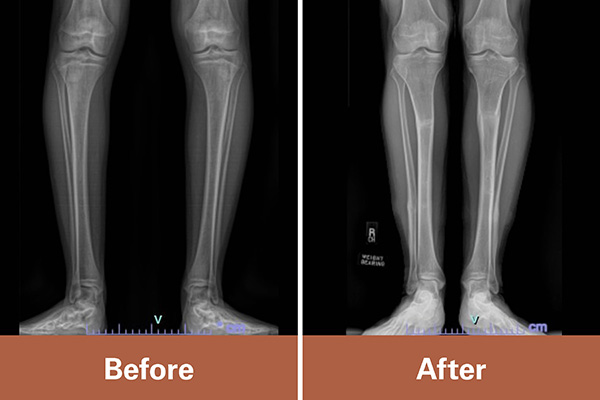 Before and after X-ray