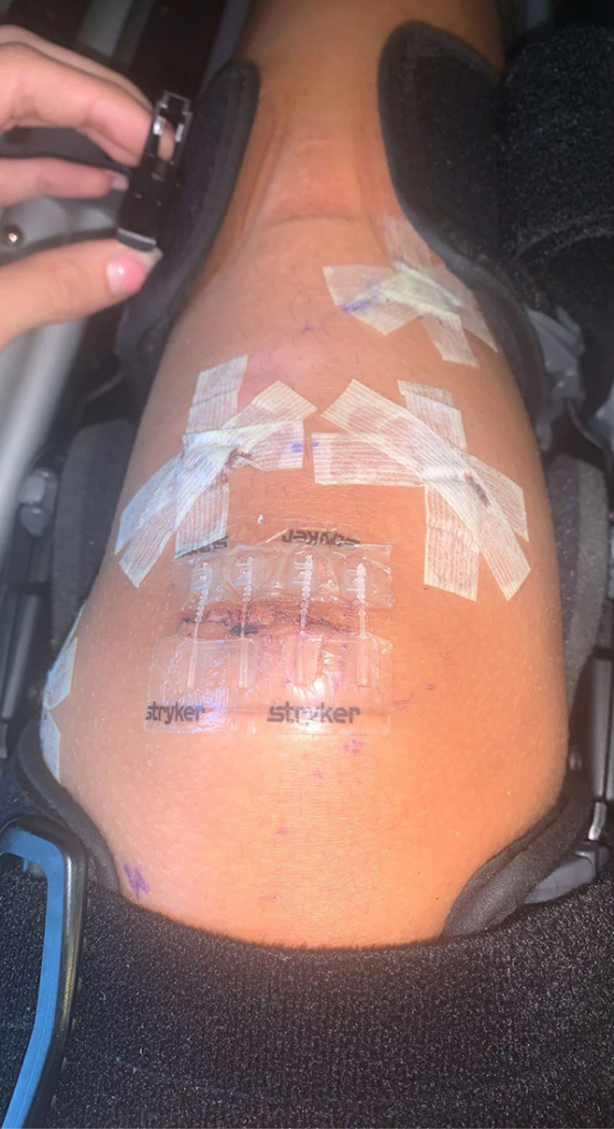 Koryn's knee showing stitches and bandages