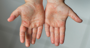 Hand, foot and mouth disease rash on palm of hands