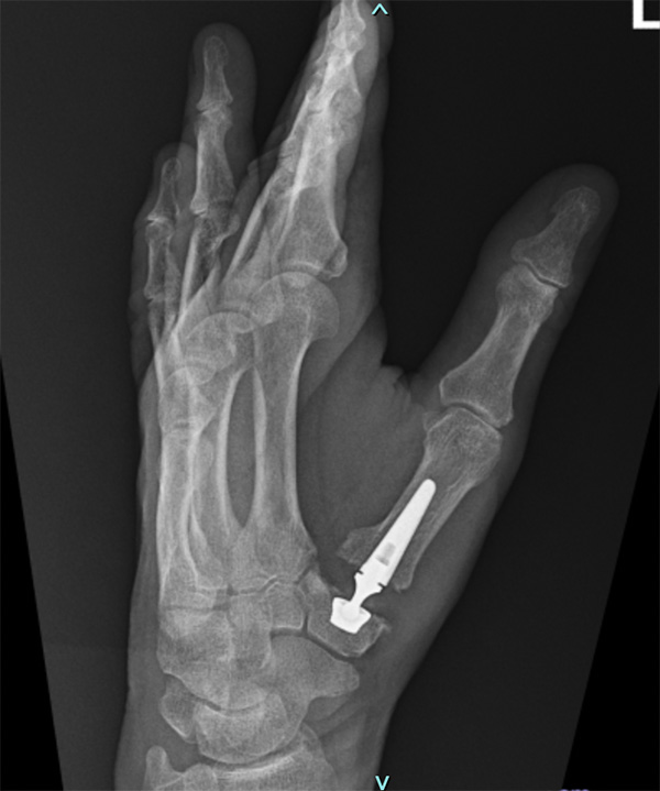 An X-ray of the left hand showing the bone after surgery.